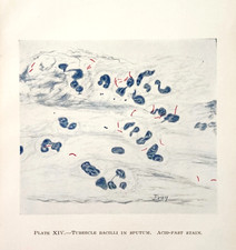 1944 Tubercle Bacilli Sputum Tuberculosis Medical Plate Print Acid Fast Stain picture