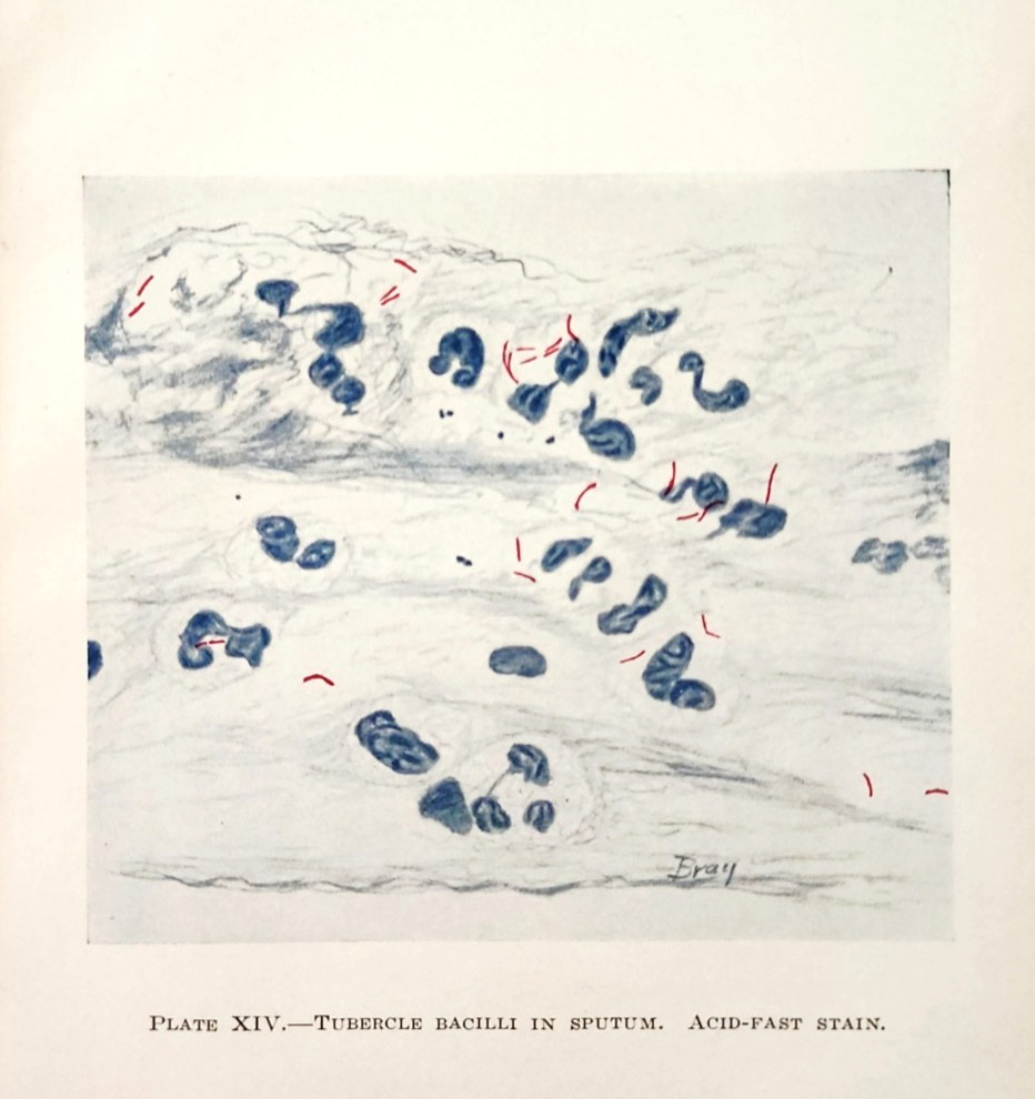 1944 Tubercle Bacilli Sputum Tuberculosis Medical Plate Print Acid Fast Stain