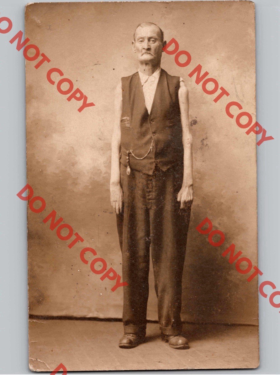 WOW c1910 Circus Sideshow Freak SKINNY ARMS Weird Body Unusual RPPC Real Photo